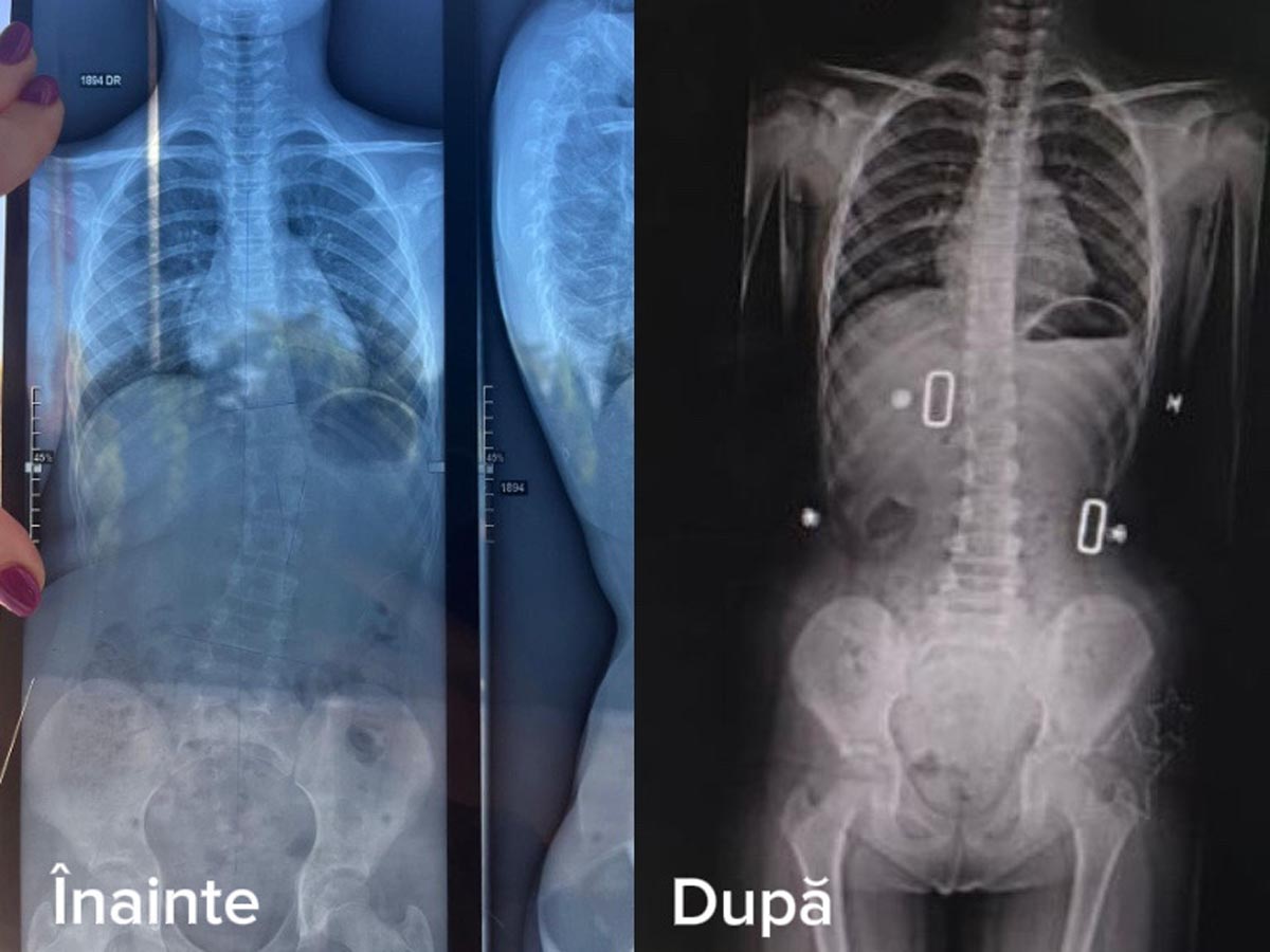 Sanconfind, scolioza, recuperare medicala, kinetoterapie, sanatate copii
